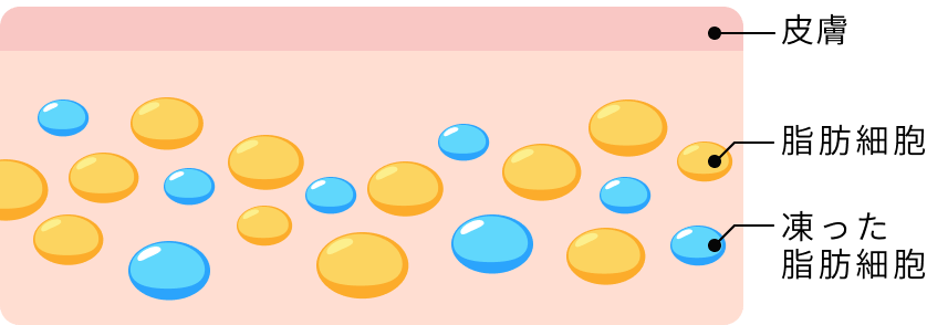 脂肪を凍らせます