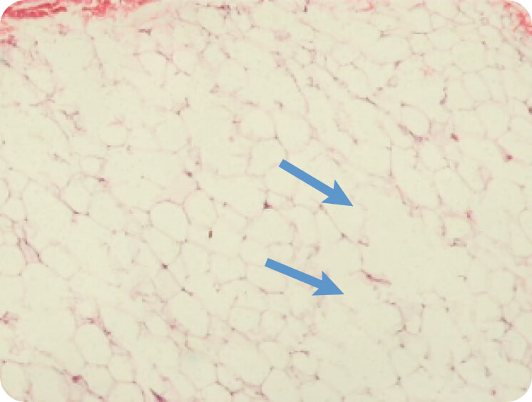 破壊された脂肪の写真、1枚目