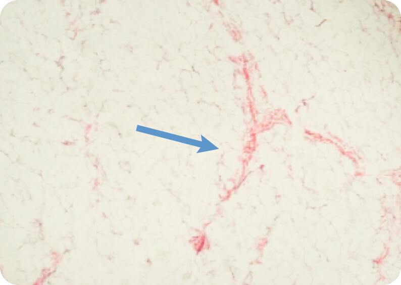 破壊された脂肪の写真、2枚目