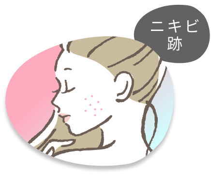 ニキビ跡